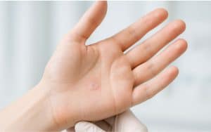 Warze abgefallen – Was bedeutet das?